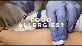 FOOD ALLERGIES?
