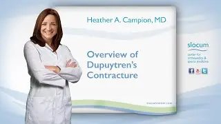 Overview of Dupuytren’s Contracture