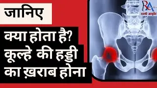 AVN (avascular necrosis) hip  कूल्हे की हड्डी का खराब होना
