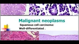 malignant tumors.compressed