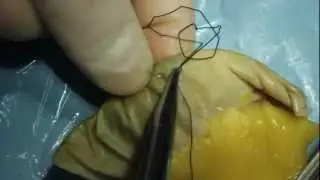 Кисетный шов. Ушивание дефекта стенки кишечника.