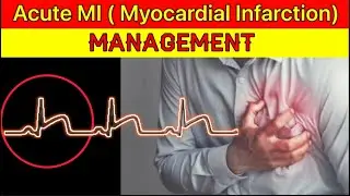 Acute MI(Myocardial Infarction) Management | Acute STEMI Management | Heart Attack Management in ER