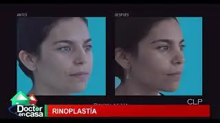 #DoctorenCasa| ¿Quién puede hacerse una Rinoplastía?| Clínica La Parva