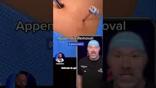 Taking Out the Appendix 😱 