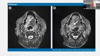 The Role of Imaging and Biopsies in Head and Neck Cancer. Part 2