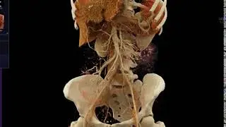 Crohn's Disease with Cinematic Rendering
