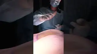 #липофилинг