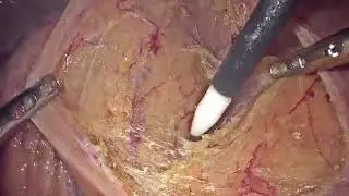 Laparoscopic radical sigmoidectomy with left colonic artery and superior rectal artery