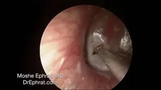 ENDOCSOPIC MUCOID OTITIS MEDIA DRAINAGE