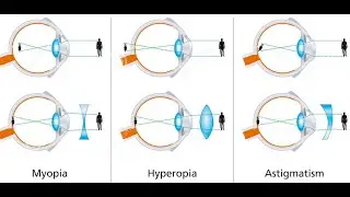 EYE DEFECTS & THEIR correction | grade 12 life sciences | ThunderEDUC | M.SAIDI