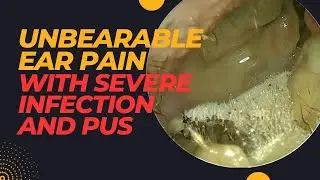 CRAZY Ear Infection Full of Pus Causing UNBEARABLE Pain