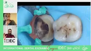 محاضرة قوية عن الDeep marginal elevation  مع نجم البايوميميتك  الدكتور #حيدر_وليد  🇮🇶🇮🇶