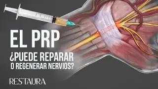 ¿El PRP puede reparar o regenerar nervios?