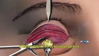 BLEFAROPLASTIA - Dra. Débora Tomatis Pacheco - Cirurgia Plástica - Porto Alegre/RS
