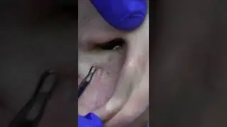 Прогресс чистить уши