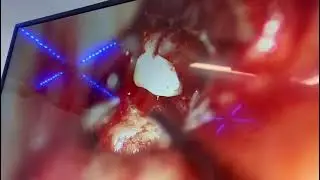 Ossiculoplasty using bone cement maintains the natural anatomy and physiology of the ossicular chain