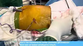 Karın zarı kanserini bu kadar yakından görmediniz! Hızlı tanı ve tedavi ameliyatını izleyin.