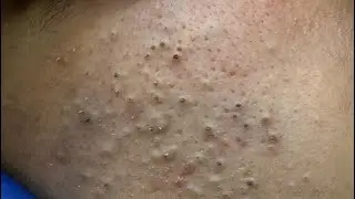Deep Pore Cleansing Facial Routine for Acne & Blackheads Removal - Satisfying ASMR