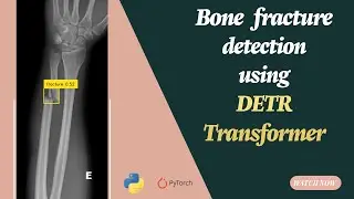 Object detection Using Detection Transformer (Detr) for Bone fraction dataset
