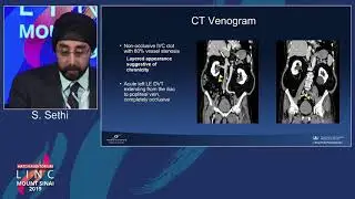 Hatch D1 - Iliac Vein Compression (May Thurner Syndrome) - Dr. Sethi