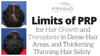 Why Hair Transplants are Not Advised When Hair is Still Dense, and How to Thicken Thinning Hair