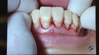 Conheça mais sobre a lente de contato dental