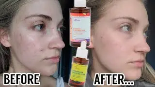 I Tried The Good Molecules Niacinamide Toner & Discoloration Correcting Serum For 2 Months!