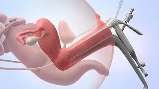 Intrauterine insemination