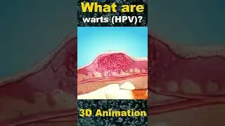 Understanding Warts: What is HPV? | Your Complete Guide