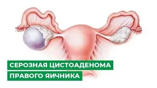 Серозная цистоаденома правого яичника