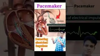 Pacemaker device | #shorts #heart #pacemaker