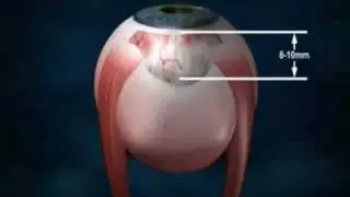 Ahmed Valve.flv
