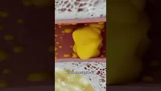 How to Remove Ear Wax Blockage the Right Way 