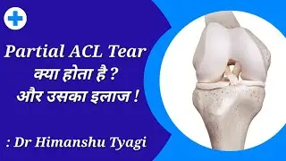 Partial ACL Tear क्या होता है ? और उसका इलाज !