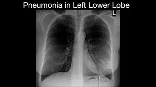 Pneumonia in Left Lower Lobe