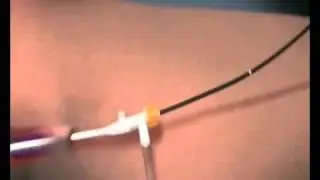 Лечение вен нижних конечностей методом РЧО