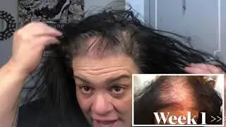 Vick Vapor Rub Hair Growth Challenge Week 2 & 3