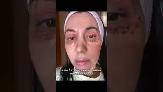 Косметолог Влада Баширова проверяет на себе процедуру безоперационной блефаропластики.
