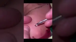 How to pop pimples