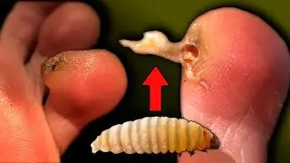 🐛 WORM in the FINGER?! callus with SURPRISE. Consequences of HOME PEDICURE. CORN. Deep Callus