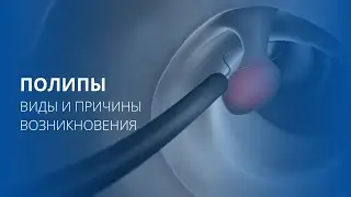 Полипы анального канала