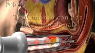 Láseres Fotona -  Incontinencia y Reafirmación - Ginecología