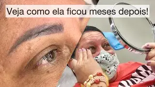 Remoção de micropigmentação a laser