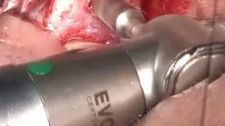 Crestal Approach Sinus Graft with Immediate Implant Placement