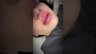 Увеличение губ 💉