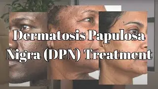 BWD - Dermatosis Papulosa Nigra (DPN) Treatment