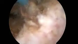 resekce hypertrofického isthmického endometria
