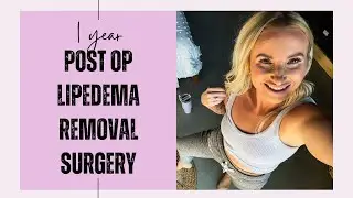 1 year post op lipedema removal surgery