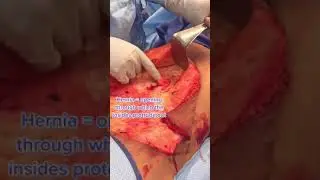 This is what a Hernia Looks Like! 