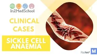 Sickle Cell Anaemia Clinical Case